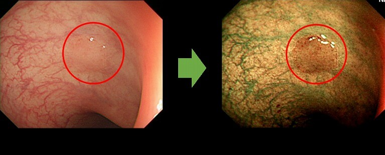 早期発見に有効なNBI
