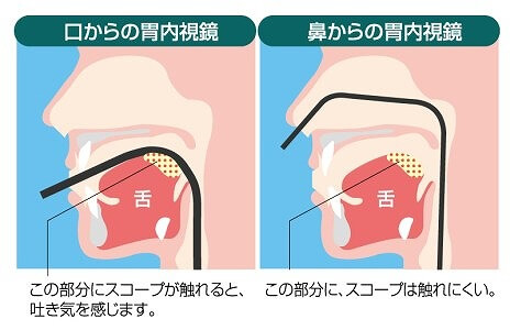 経口・経鼻のお好きな方をお選びいただけます